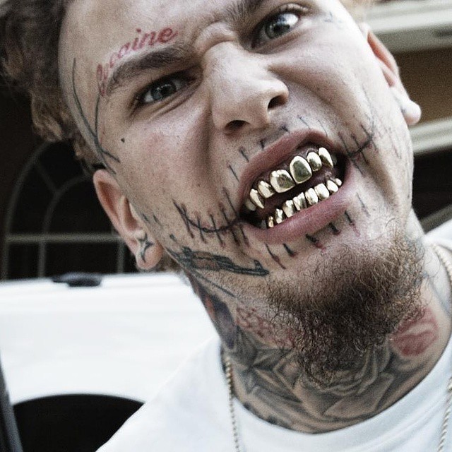 stitches